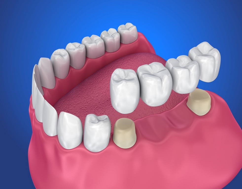 common-dental-bridge-complications 1 common-dental-bridge-complications 1